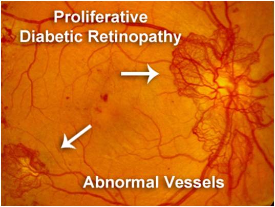 proliferative Diabetic Retinopathy