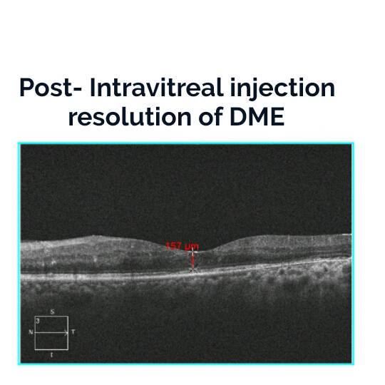 Post- Intravitreal injection resolution of DME