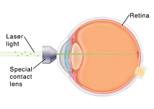 Retinal Laser photocoagulation 